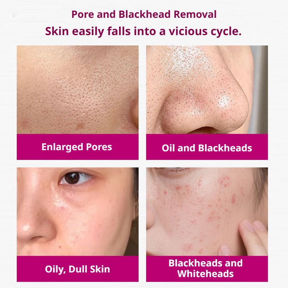 Salicylzuur Serum voor het ver - Azelaic Acid Serum recensie en prijs
