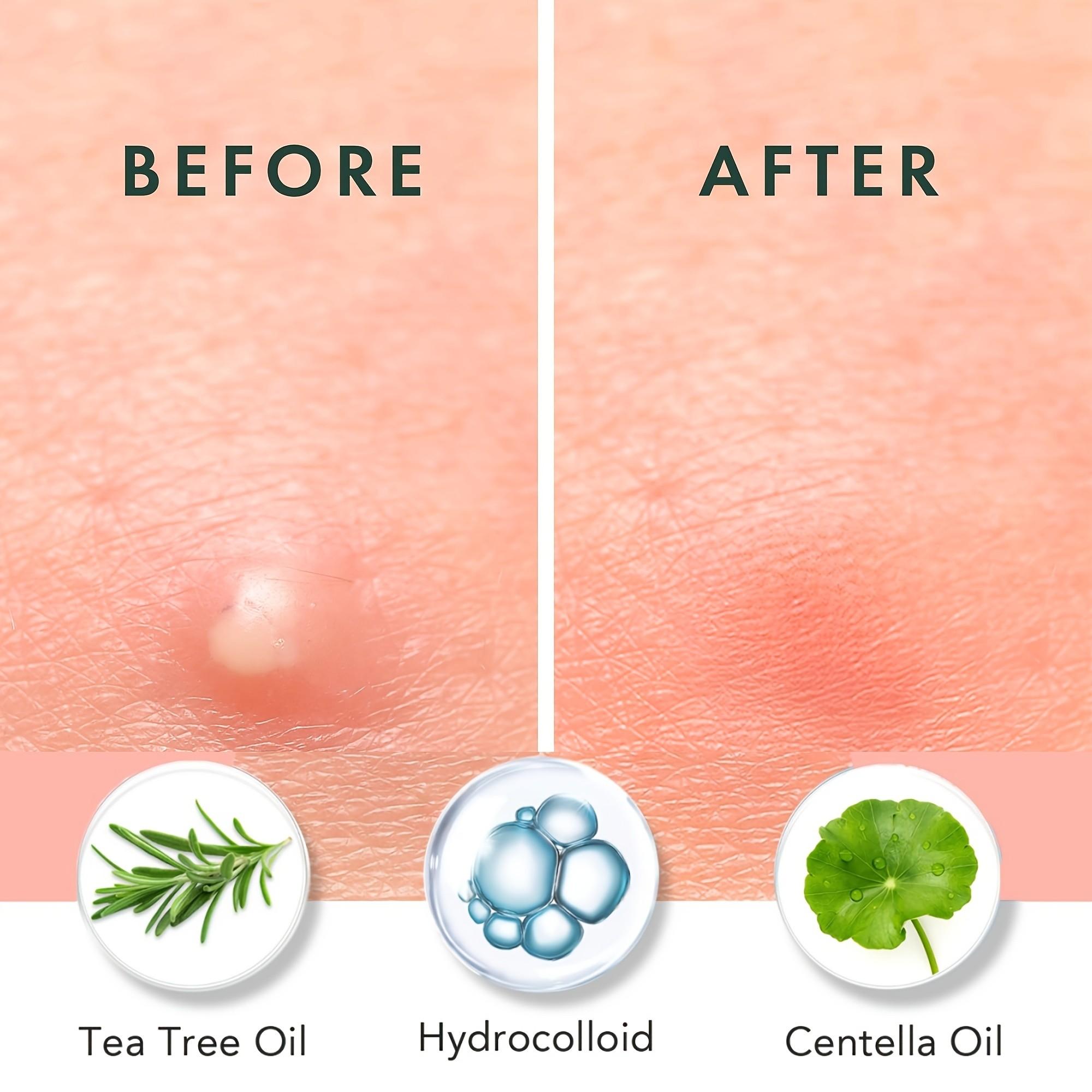 180/360/720 stuks acnepleister - Skincare Moisturizer recensie en prijs